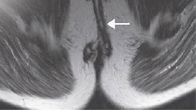 bai-viet/ro-hau-mon-hinh-mong-ngua-nguyen-nhan-chan-doan-cach-dieu-tri-va-phong-ngua.html