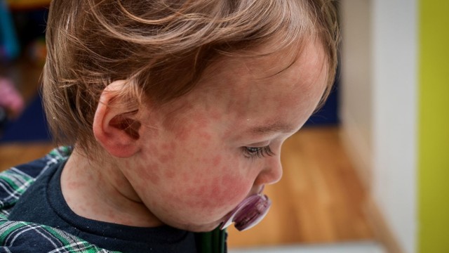 bai-viet/tinh-trang-rom-say-o-tre-em-va-nhung-thong-tin-cha-me-can-biet.html