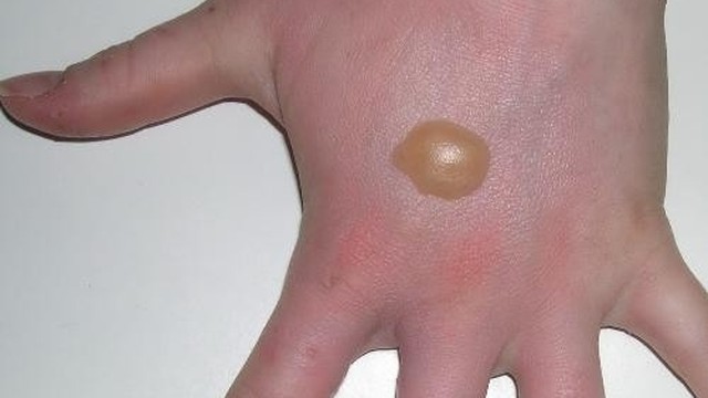 bai-viet/rua-vet-bong-bi-vo-bang-gi-cac-phuong-phap-so-cuu-vet-bong-an-toan.html