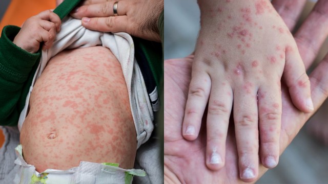 bai-viet/rubella-co-phai-la-benh-soi-khong-cach-phong-benh-rubella-hieu-qua.html
