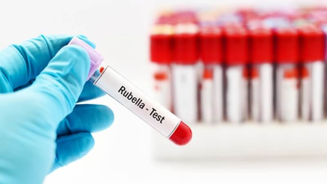 bai-viet/rubella-ig-g-duong-tinh-chi-so-bao-nhieu-la-binh-thuong.html