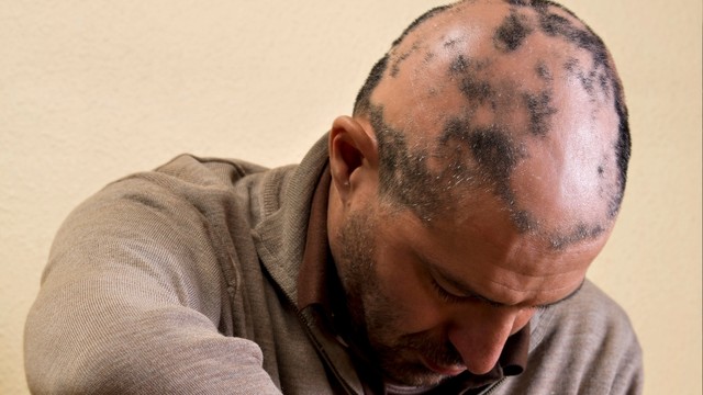 bai-viet/rung-toc-tung-mang-nguyen-nhan-va-cach-dieu-tri-hieu-qua.html