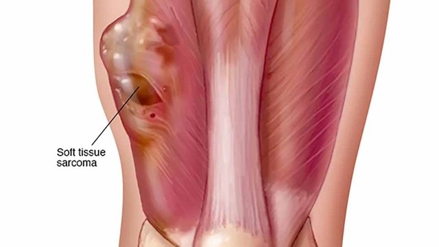bai-viet/sarcoma-co-van-o-tre-em-khai-niem-phan-loai-va-mo-ta-63456.html