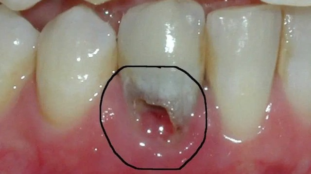 bai-viet/nguyen-nhan-sau-chan-rang-hau-qua-va-cach-phong-ngua-hieu-qua.html