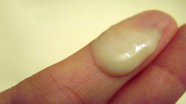 bai-viet/sau-khi-dot-viem-lo-tuyen-ra-dich-vang-co-binh-thuong-khong.html