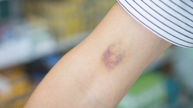 bai-viet/sau-khi-hien-mau-tay-bi-bam-tim-nguyen-nhan-va-cach-xu-ly-64954.html