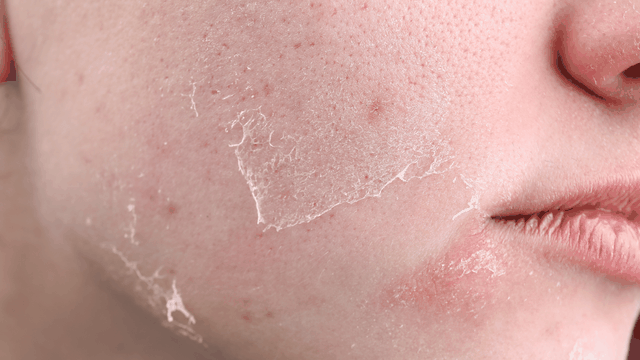 bai-viet/sau-khi-peel-da-co-nen-dung-serum-b5-khong-nhung-thong-tin-can-biet.html