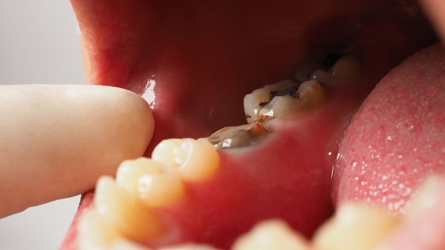 bai-viet/nhan-biet-som-va-cach-xu-ly-kip-thoi-tinh-trang-sau-rang-o-nguoi-lon.html