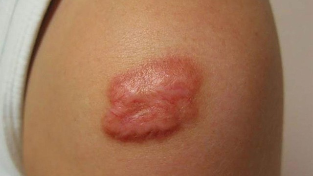 bai-viet/seo-do-bao-lau-thi-het-cach-dieu-tri-seo-do-hieu-qua-60673.html