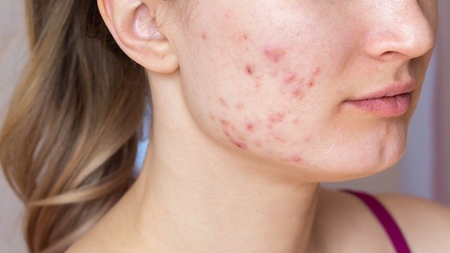 bai-viet/seo-do-bao-lau-thi-het-cach-nhanh-het-seo-do-62350.html