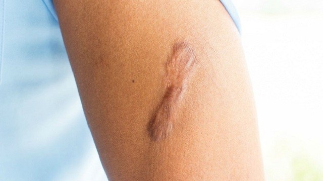 bai-viet/tai-sao-seo-loi-ngua-va-dau-cach-giam-ngua-va-dau-do-seo-loi-hieu-qua.html