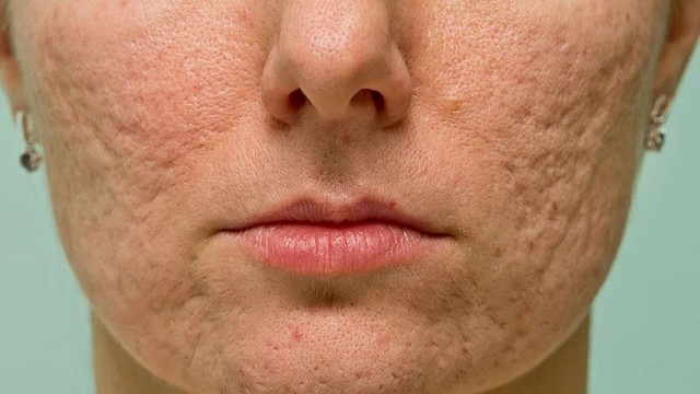 bai-viet/seo-ro-la-gi-kinh-nghiem-tri-seo-ro-lau-nam-khong-phai-ai-cung-biet.html