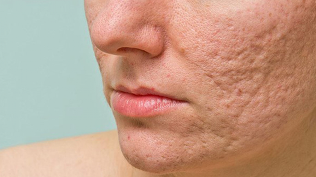 bai-viet/nguyen-nhan-hinh-thanh-seo-ro-nang-va-cach-dieu-tri-hieu-qua.html