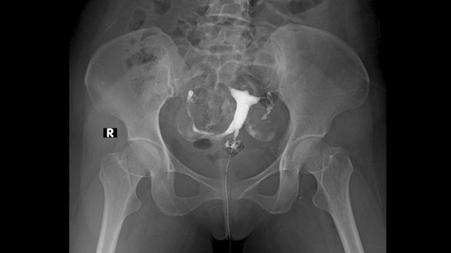 bai-viet/sieu-am-bom-nuoc-buong-tu-cung-bi-ra-mau-co-nguy-hiem-khong.html