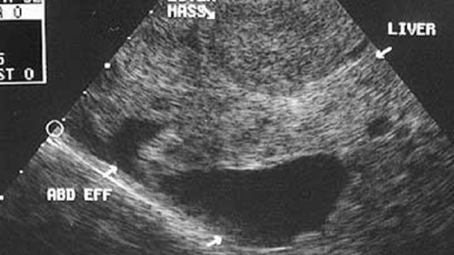 bai-viet/sieu-am-co-phat-hien-ung-thu-gan-vai-tro-cua-tam-soat-ung-thu-gan-som.html