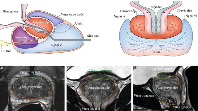bai-viet/cac-truong-hop-can-sinh-thiet-tuyen-tien-liet-qua-huong-dan-cua-sieu-am-ket-hop-mri.html