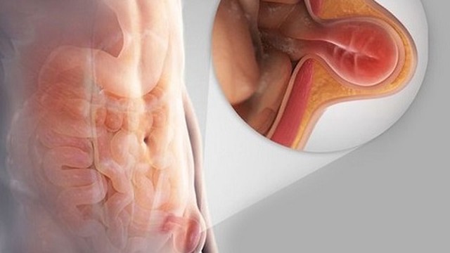 bai-viet/mo-thoat-vi-ben-bao-lau-thi-lanh.html