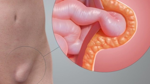 bai-viet/mo-thoat-vi-ben-co-nguy-hiem-khong-cac-phuong-phap-dieu-tri-cho-benh-nhan.html