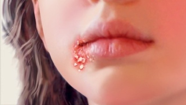 bai-viet/benh-choc-lo-bao-lau-thi-khoi-can-luu-y-gi-trong-qua-trinh-dieu-tri-benh-1.html