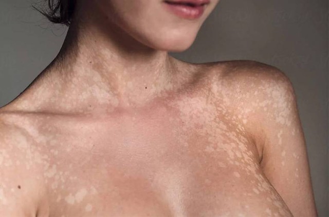 bai-viet/benh-lang-ben-co-lay-khong-con-duong-lay-lan-cua-lang-ben-52992.html