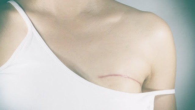 bai-viet/cham-soc-tai-gia-dinh-sau-phau-thuat-danh-cho-benh-nhan-ung-thu-vu-56794.html