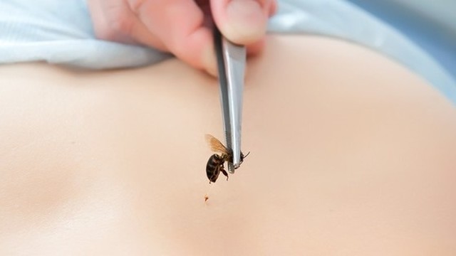 bai-viet/di-ung-con-trung-dot-phai-lam-sao.html