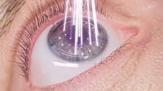 bai-viet/khi-nao-can-mo-mat-can-thi-nhung-dieu-can-luu-y-truoc-khi-mo-la-gi.html