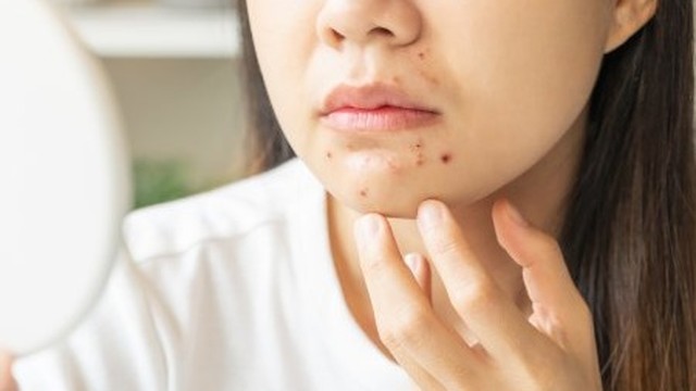 bai-viet/mun-cam-o-cam-nguyen-nhan-dau-hieu-va-cach-dieu-tri.html