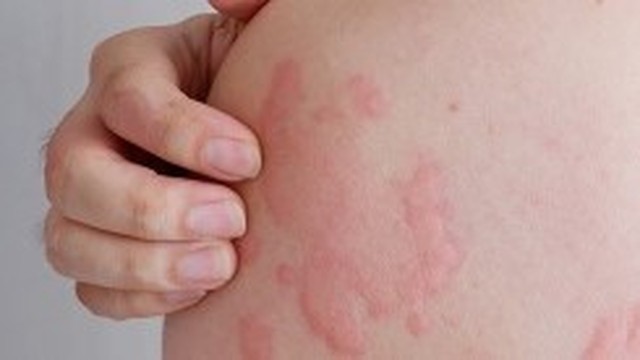 bai-viet/bi-phong-ngua-nguyen-nhan-do-dau-phuong-phap-dieu-tri-va-phong-tranh-benh-phong-ngua.html