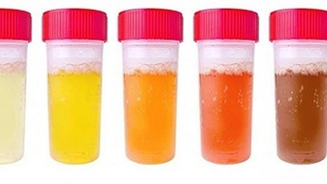 bai-viet/nuoc-tieu-dam-mau-co-bi-sao-khong-dau-hieu-cua-benh-gi.html