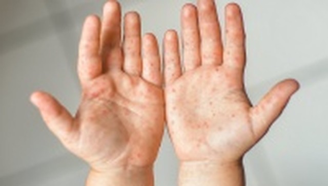 bai-viet/tay-chan-mieng-do-1-may-ngay-thi-khoi-can-luu-y-nhung-gi.html