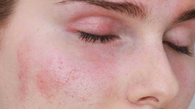 bai-viet/test-ap-bi-la-gi-nhung-luu-y-khi-thuc-hien-test-ap-bi.html