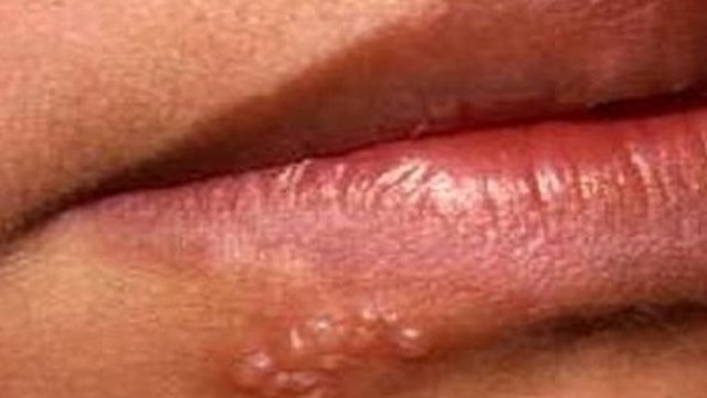 bai-viet/thuc-hu-ve-benh-mun-rop-sinh-duc-co-tu-khoi-58780.html