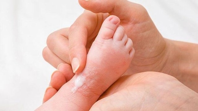 bai-viet/thuoc-eumovate-cream-dung-cho-tre-so-sinh-co-duoc-khong.html