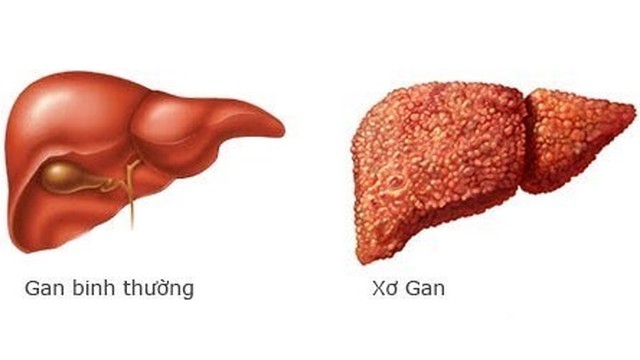 bai-viet/tieu-chuan-chan-doan-xo-gan-la-gi-dieu-tri-benh-xo-gan-nhu-the-nao.html