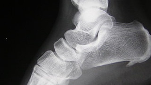 bai-viet/viem-can-gan-chan-bao-lau-thi-khoi-56652.html