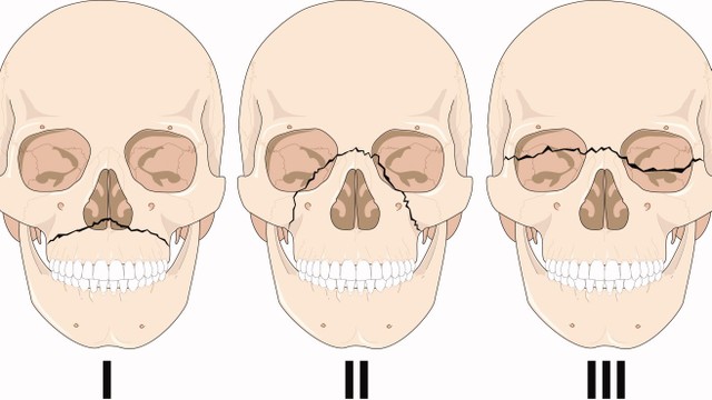 bai-viet/cach-so-cuu-tai-cho-gay-xuong-ham-tren-57578.html