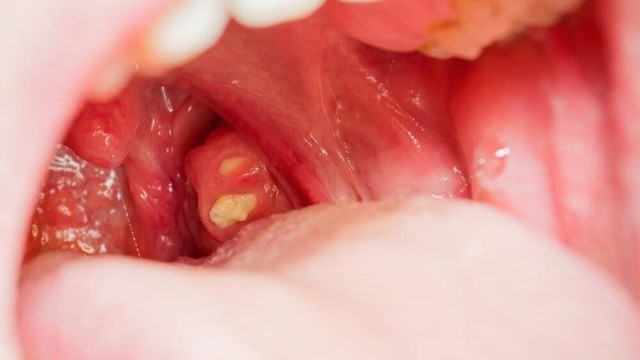 bai-viet/soi-amidan-co-tu-khoi-khong-co-gay-ra-bien-chung-gi-khong.html