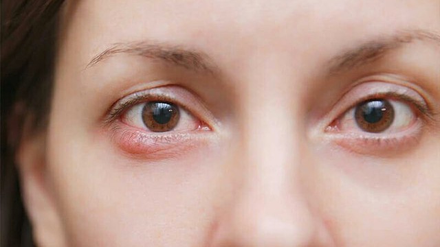 bai-viet/soi-goc-tien-phong-la-gi-nhung-thong-tin-can-biet-ve-soi-goc-tien-phong.html