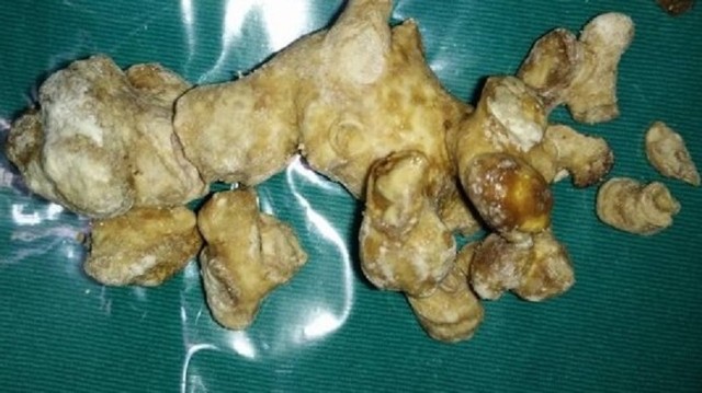 bai-viet/soi-san-ho-dau-hieu-va-cac-phuong-phap-dieu-tri-hieu-qua.html