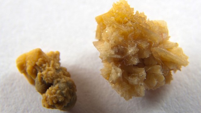 bai-viet/soi-than-hinh-thanh-nhu-the-nao-cac-loai-soi-than-thuong-gap-nhat.html