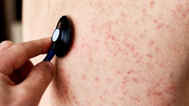 bai-viet/sot-phat-ban-dang-soi-co-nguy-hiem-khong.html