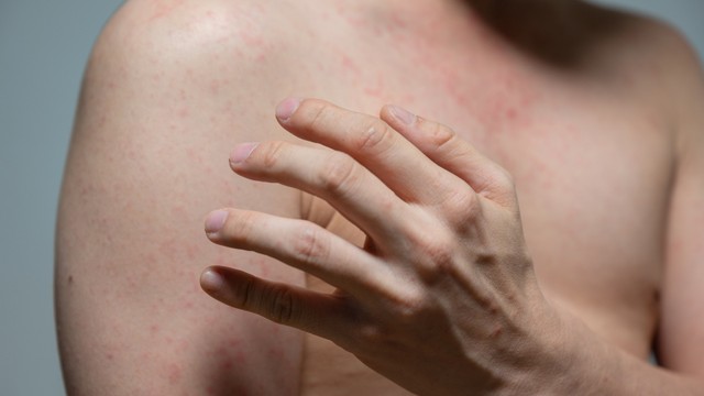 bai-viet/sot-phat-ban-o-nguoi-lon-trieu-chung-nguyen-nhan-va-cach-dieu-tri-hieu-qua.html