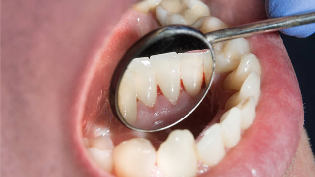 bai-viet/sot-xuat-huyet-chay-mau-chan-rang-co-nguy-hiem-khong.html