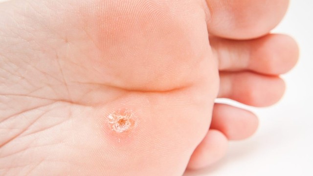 bai-viet/su-dung-acid-salicylic-tri-mun-coc-57761.html