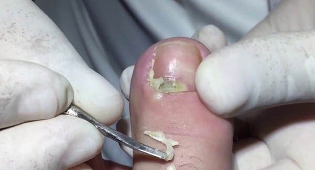 bai-viet/huong-dan-su-dung-cay-lay-khoe-mong-chan-dung-cach-58675.html