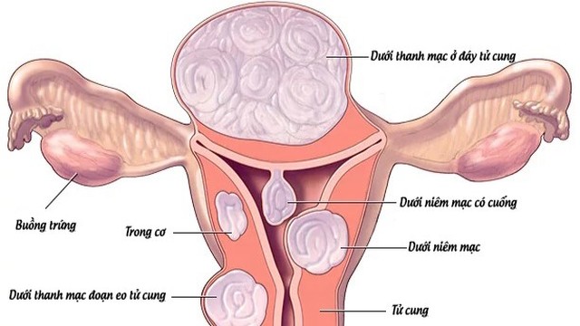 bai-viet/su-nguy-hiem-cua-tinh-trang-u-xo-tu-cung-bi-voi-hoa-57171.html