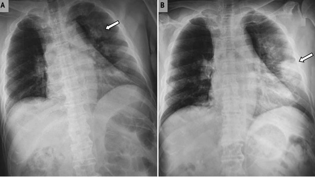 bai-viet/benh-phoi-trang-song-duoc-bao-lau-co-anh-huong-den-tuoi-tho-khong.html