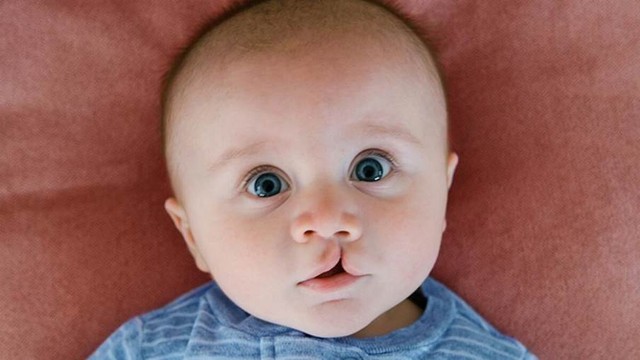 Sứt môi và hở hàm ếch