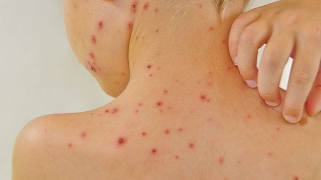 bai-viet/thuoc-tim-la-gi-tac-dung-cua-thuoc-tim-giup-ho-tro-dieu-tri-benh-ly-da-lieu-o-nguoi-lon-va-tre-nho.html